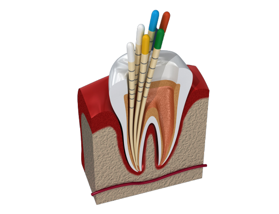 endodontie
