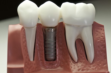 implant dentar